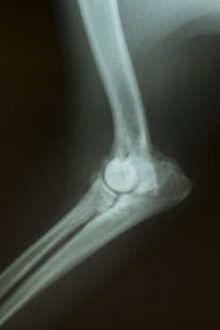 Arthrose - Röntgenbild vom Ellenbogen